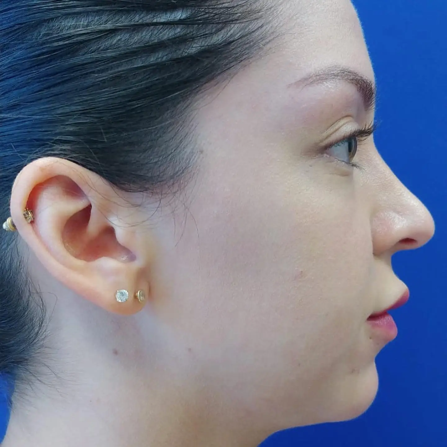 Patient profile showing chin augmentation result after cosmetic surgery in Fort Lee, NJ